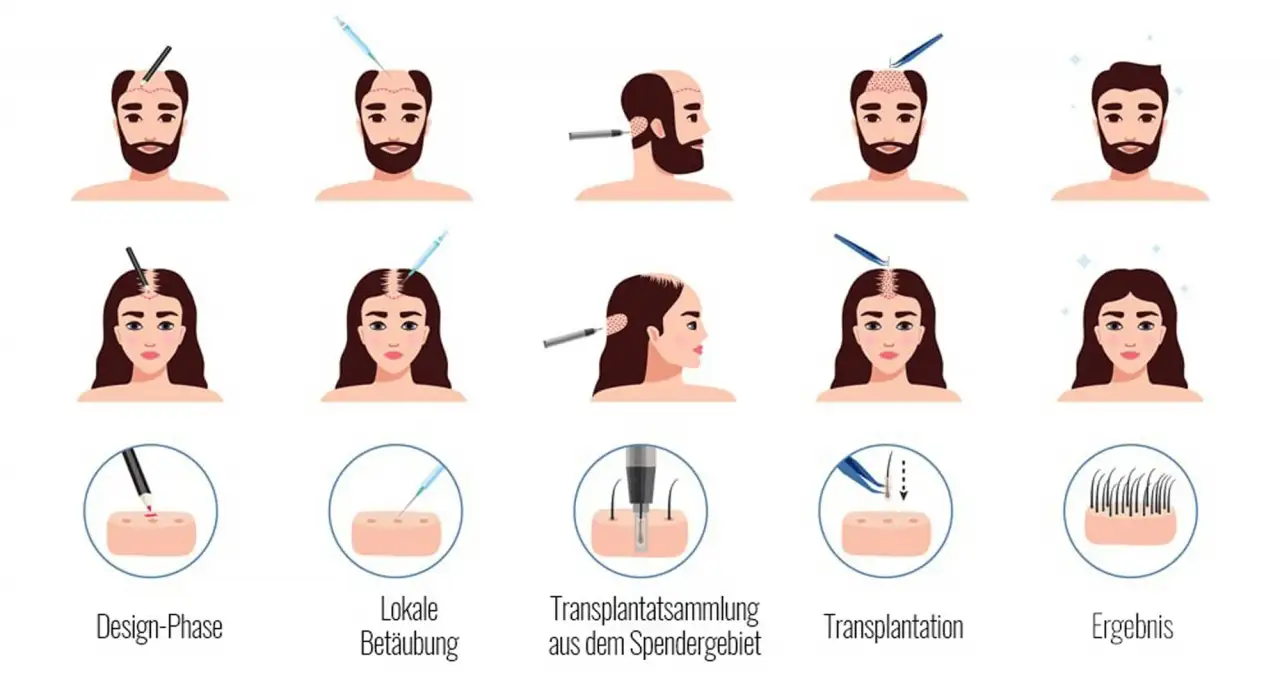 Haartransplantation techniken