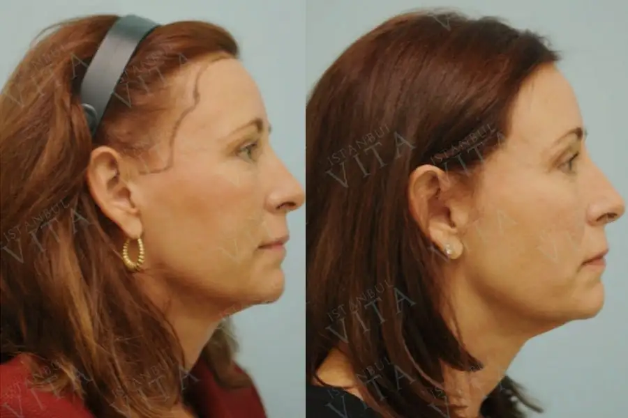 Vorteile der Haartransplantation bei Frauen