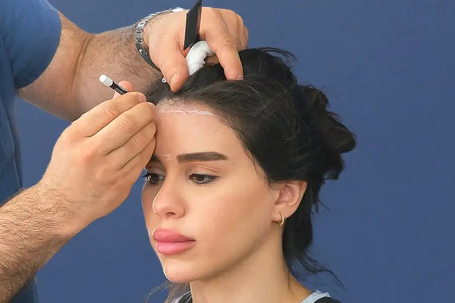 Haartransplantation bei Frauen