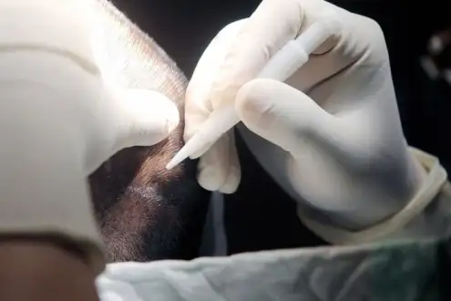 ▷ DHI Haartransplantation in Istanbul - Türkei | Kosten 2024
